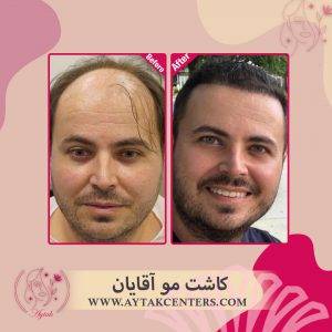 کاشت مو بانوان | کاشت مو آقایان | پیوند مو طبیعی