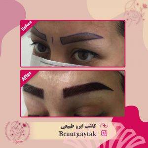کاشت ابرو | عوارض زودگذر کاشت ابرو