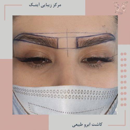 natural-eyebrow-implants