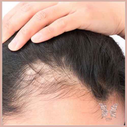 میکرونیدلینگ مو