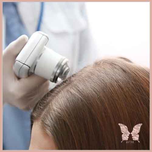 میکرونیدلینگ مو