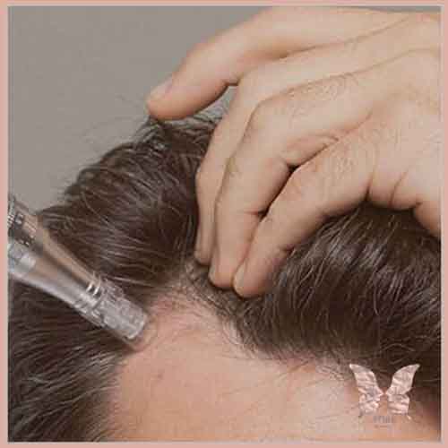 میکرونیدلینگ مو