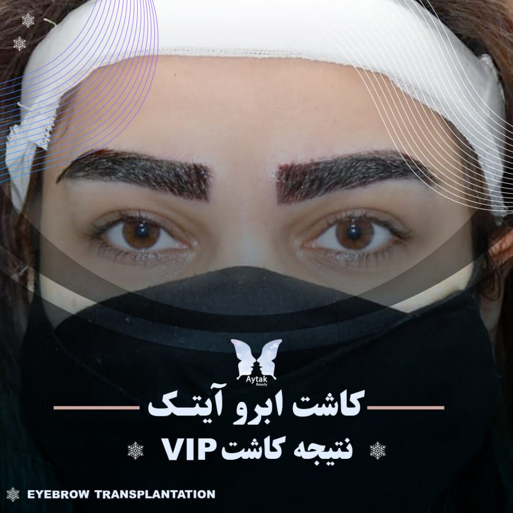 نتیجه کاشت vip