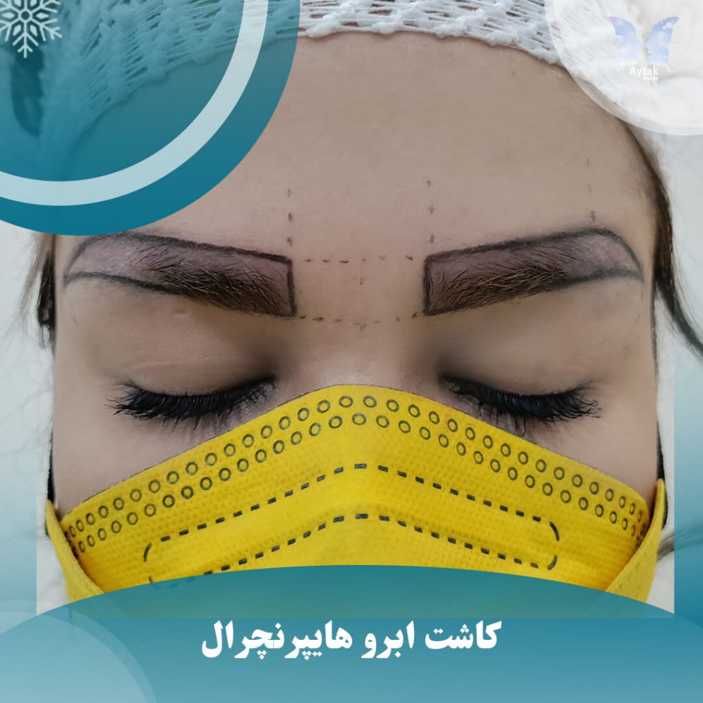 کاشت ابروی هایپرنچرال