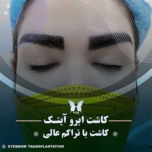 کاشت با تراکم عالی