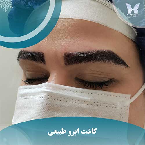 نتیجه کاشت ابرو طبیعی و عالی