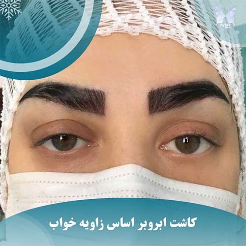 کاشت ابرو بر اساس زاویه خواب