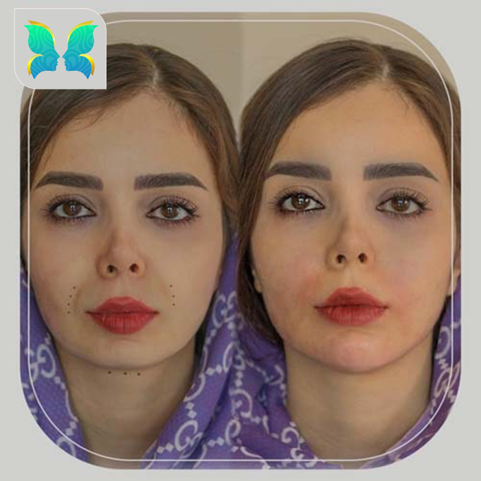 فیلر خط خنده در مرکز زیبایی راستین