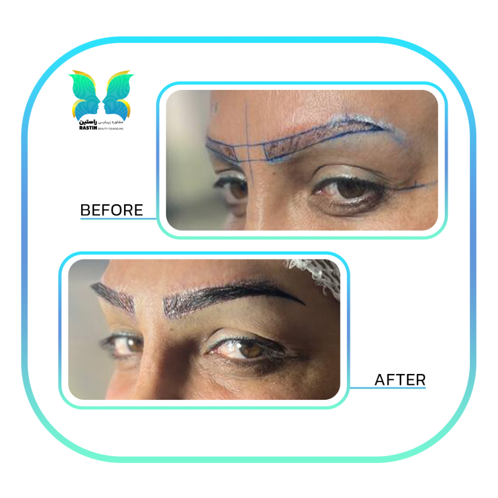 کاشت ابرو طبیعی در مرکز مشاوره زیبایی راستین