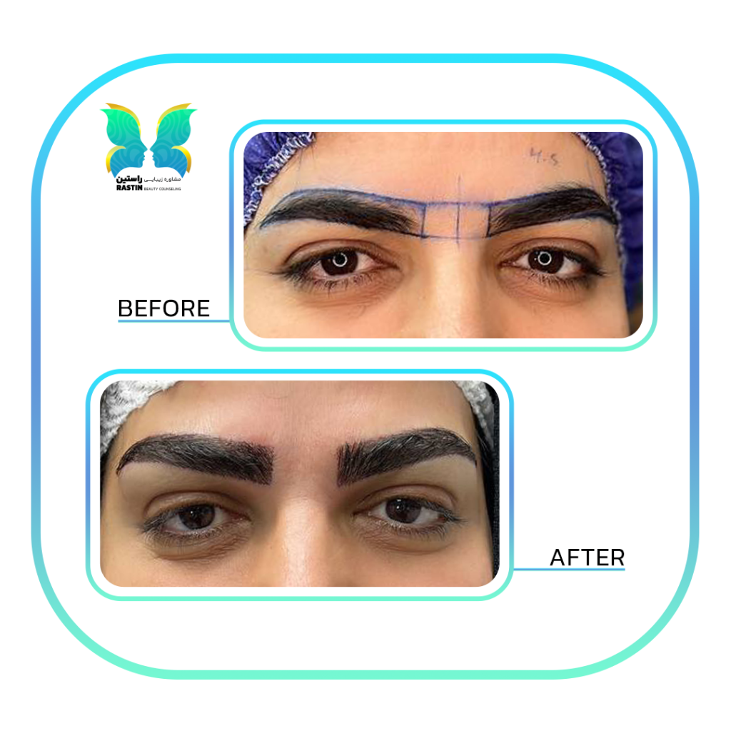 کاشت ابرو طبیعی در مرکز مشاوره زیبایی راستین
