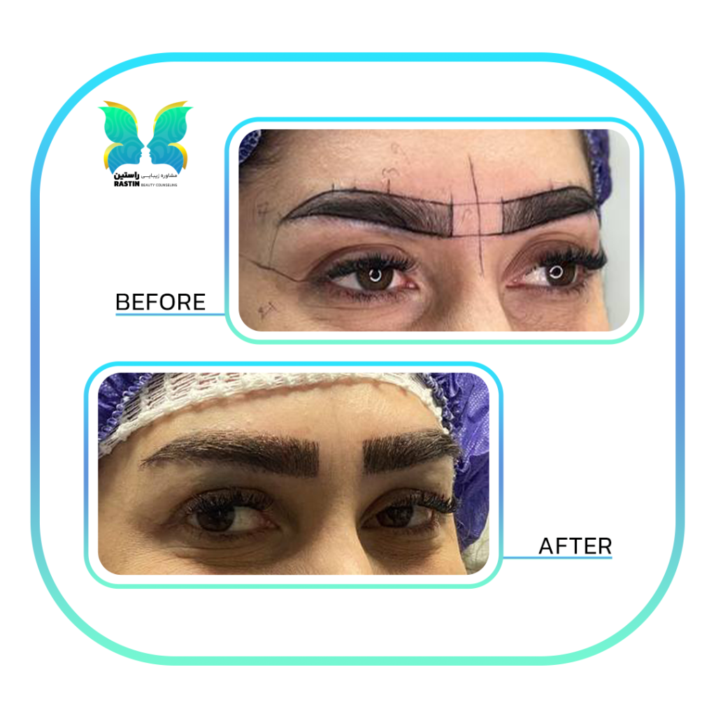 کاشت ابرو طبیعی در مرکز مشاوره زیبایی راستین