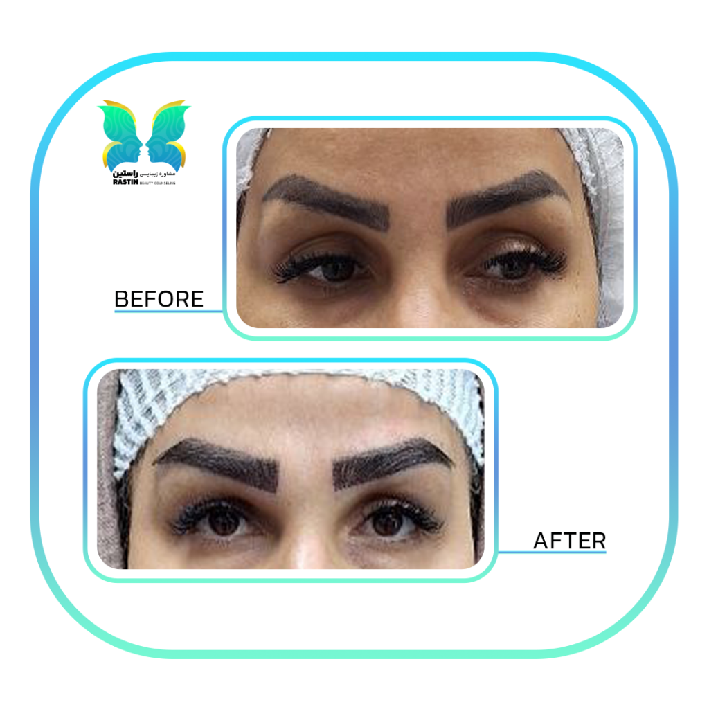 کاشت ابرو طبیعی در مرکز مشاوره زیبایی راستین