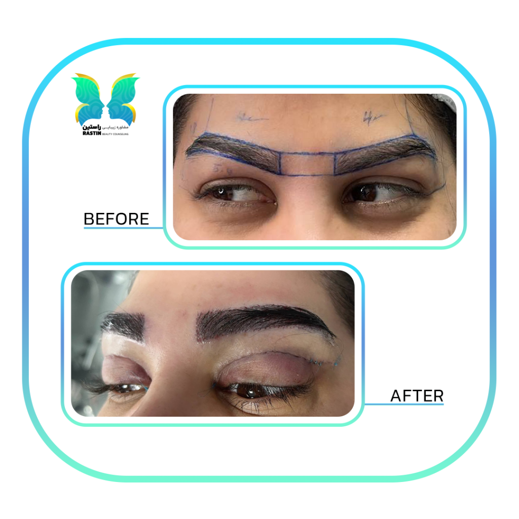 کاشت ابرو طبیعی در مرکز مشاوره زیبایی راستین
