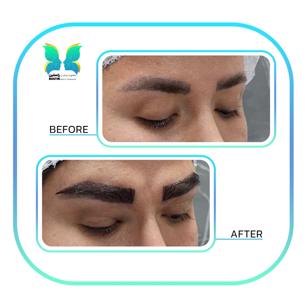 کاشت ابرو طبیعی در مرکز مشاوره زیبایی راستین