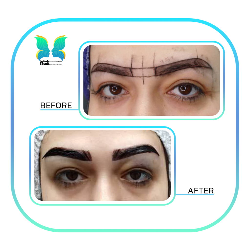 کاشت ابرو طبیعی در مرکز مشاوره زیبایی راستین