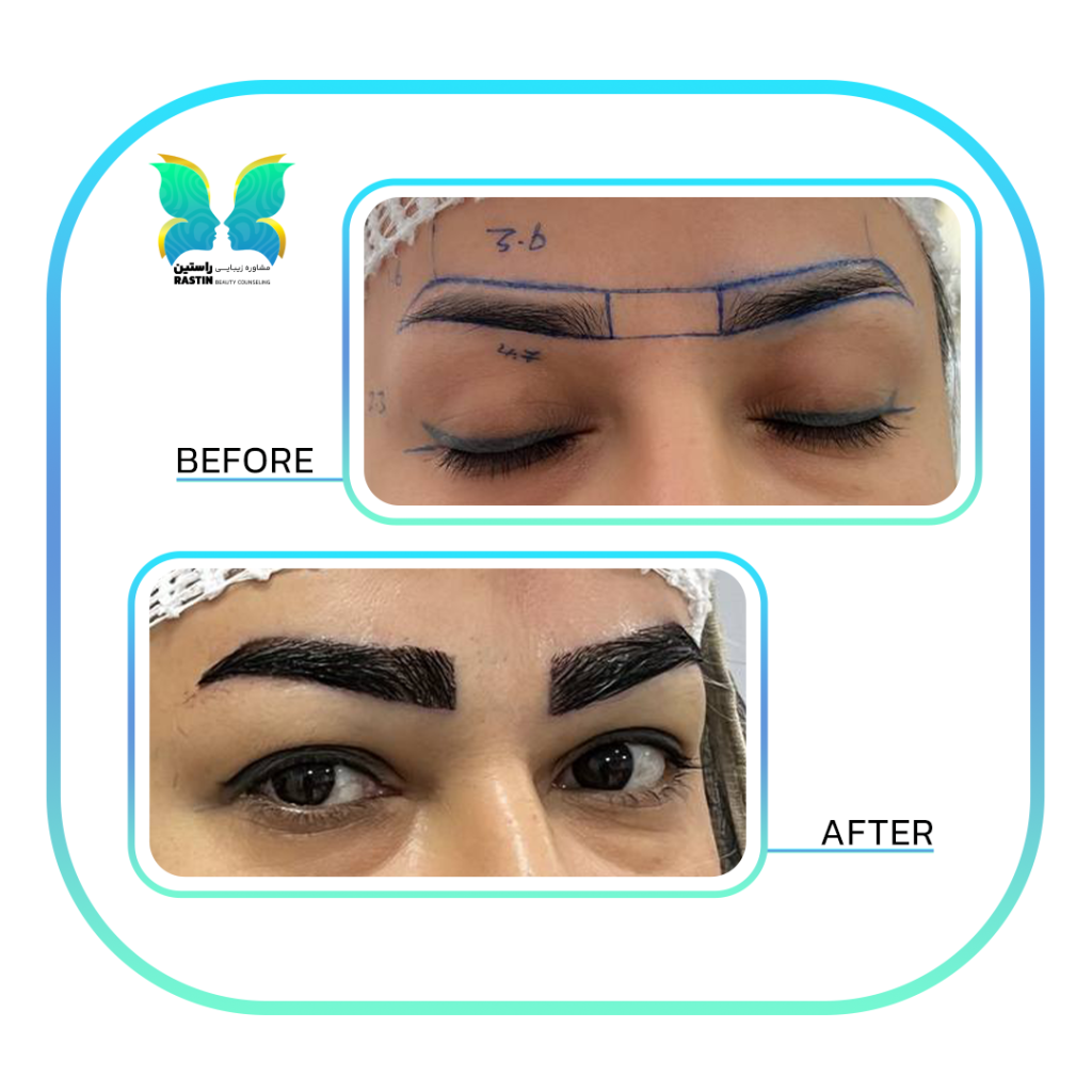 کاشت ابرو طبیعی در مرکز مشاوره زیبایی راستین