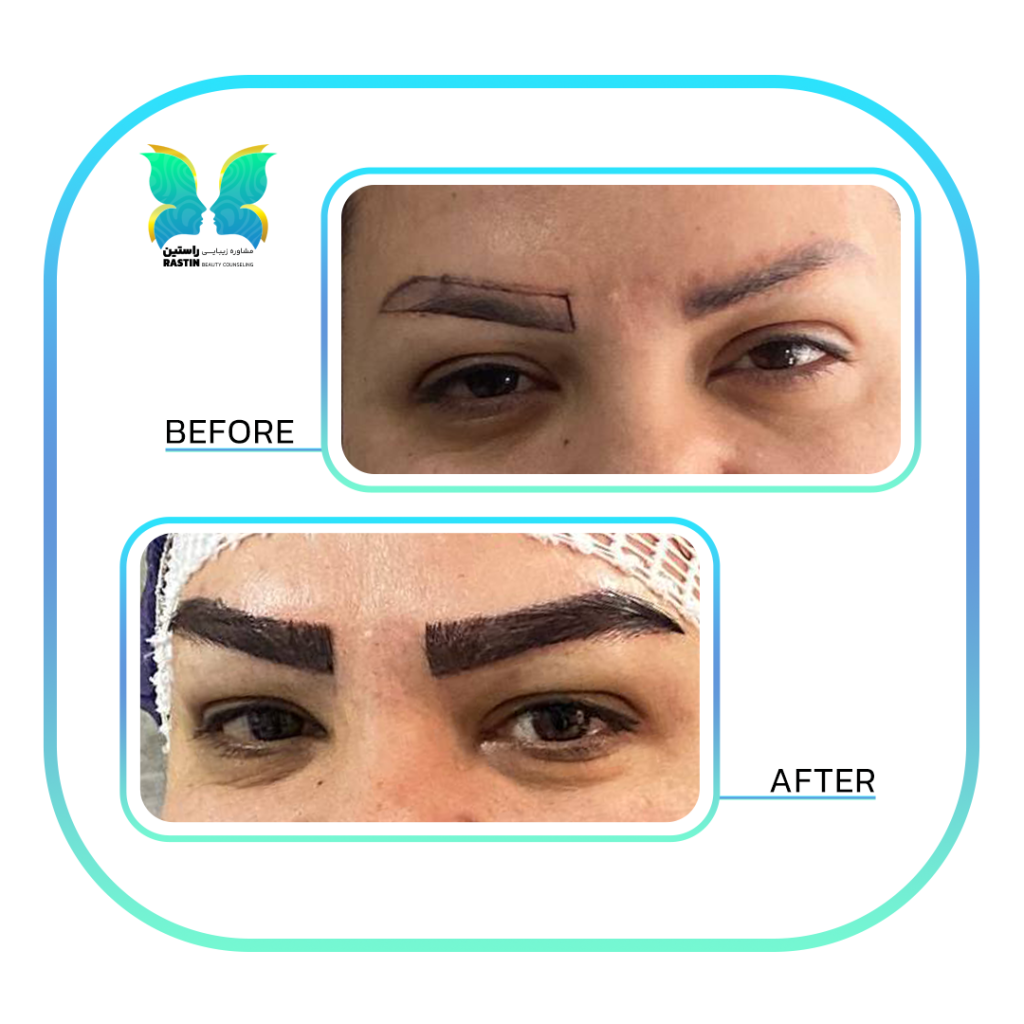 کاشت ابرو طبیعی در مرکز مشاوره زیبایی راستین