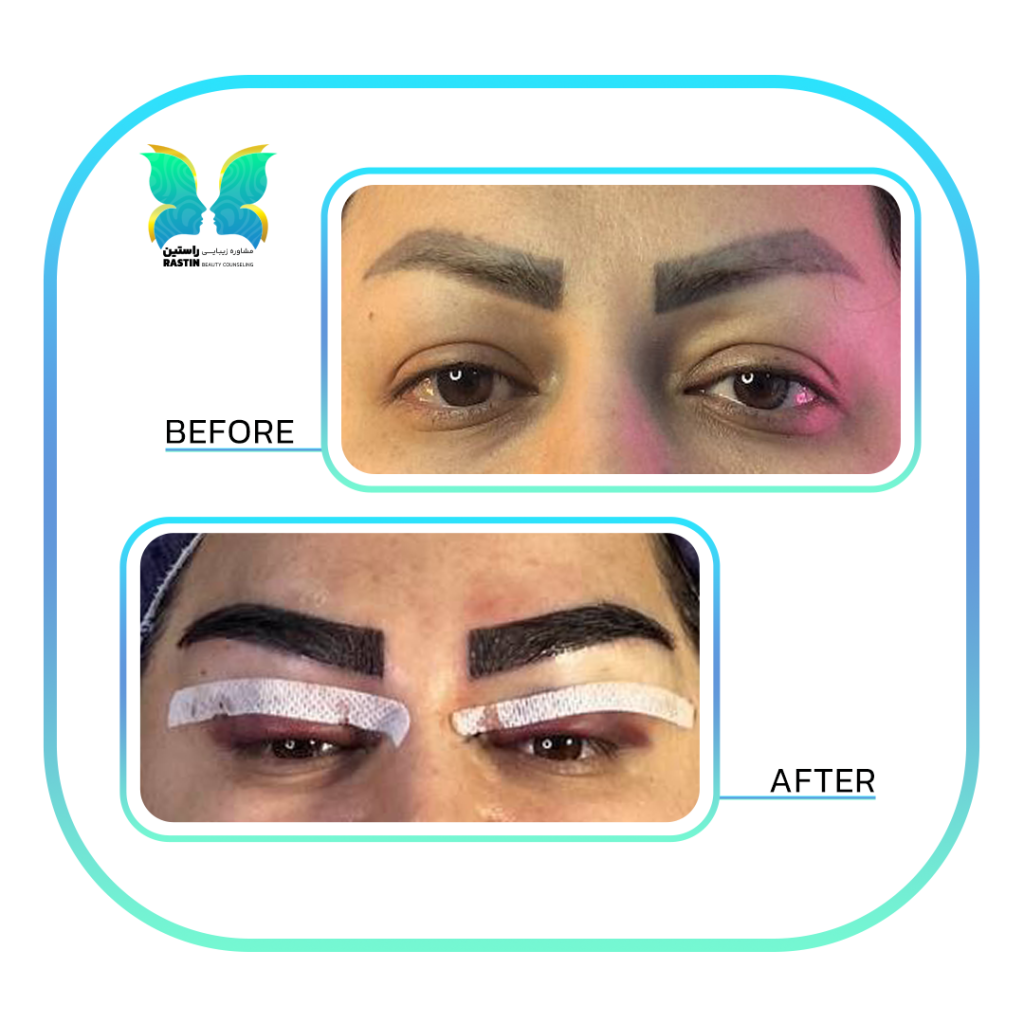 کاشت ابرو طبیعی در مرکز مشاوره زیبایی راستین