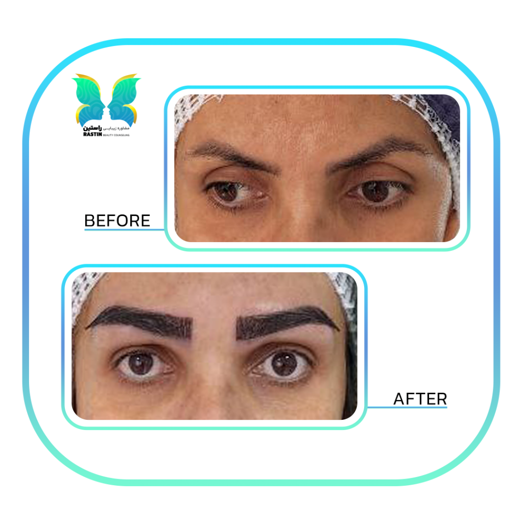 کاشت ابرو طبیعی در مرکز مشاوره زیبایی راستین