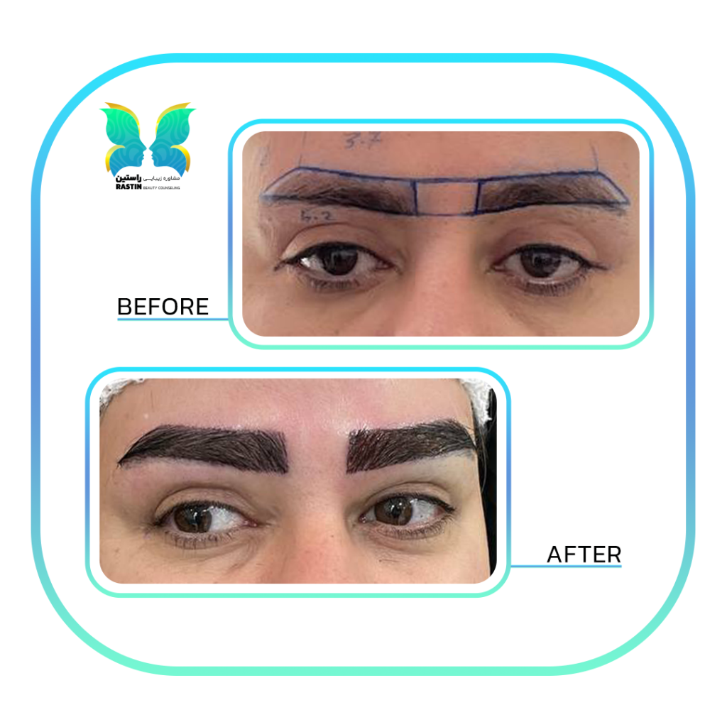 کاشت ابرو طبیعی در مرکز مشاوره زیبایی راستین