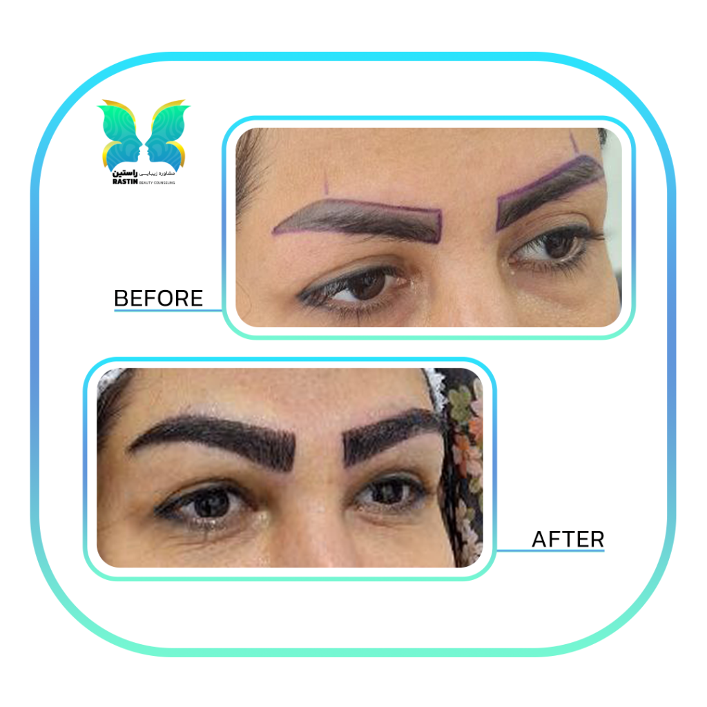 کاشت ابرو طبیعی در مرکز مشاوره زیبایی راستین