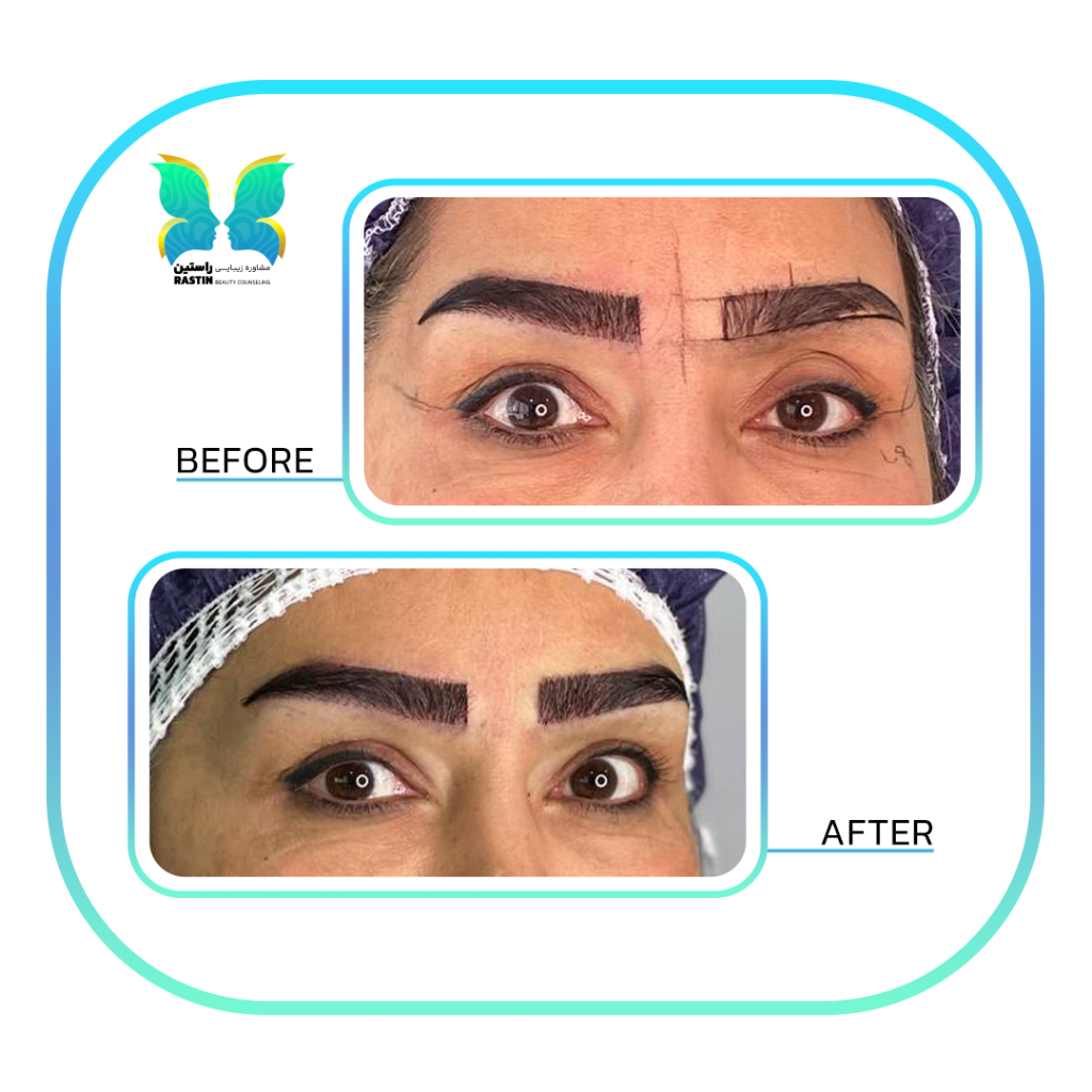 کاشت ابرو طبیعی در مرکز مشاوره زیبایی راستین