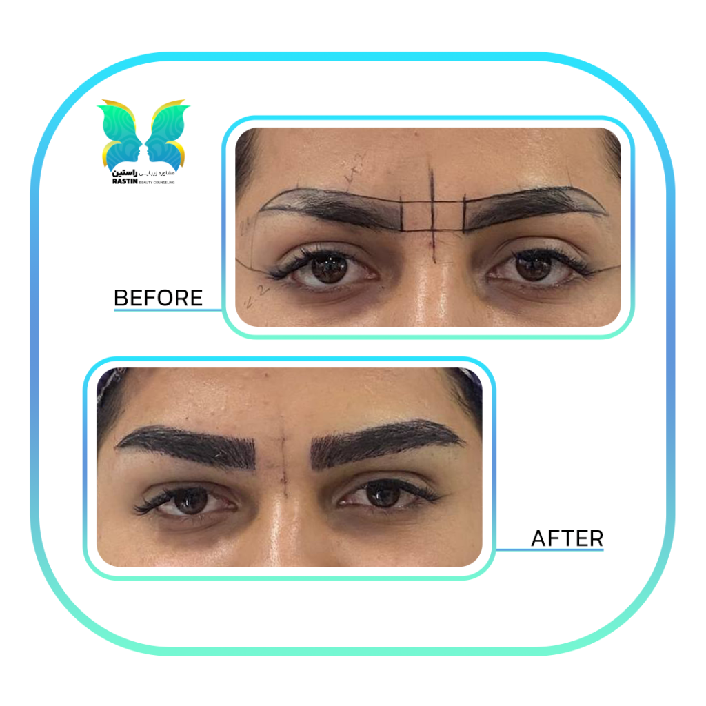 کاشت ابرو طبیعی در مرکز مشاوره زیبایی راستین